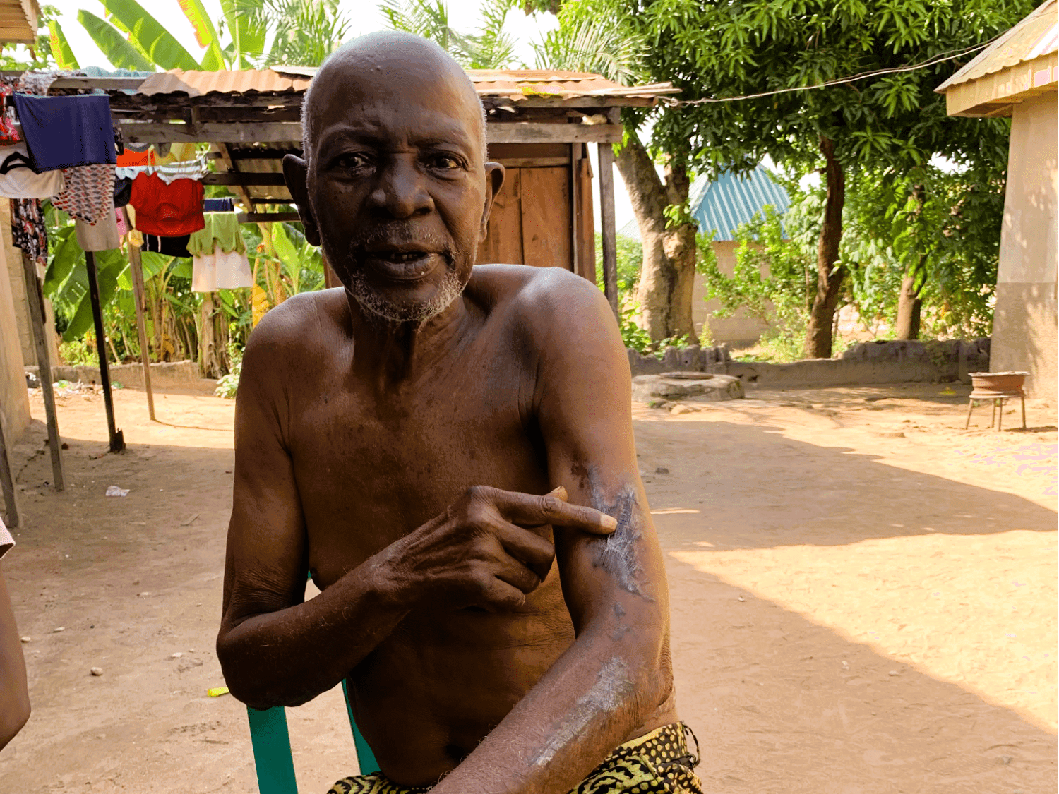 Justin Kyadoo points at his hand, scarred by the burn wounds from when his accusers attempted to burn him. Photo: Chigozie Victor/HumAngle.