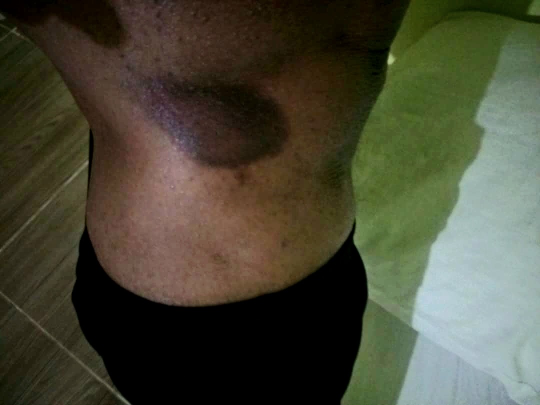 Close-up of a person's side torso showing a large bruise.