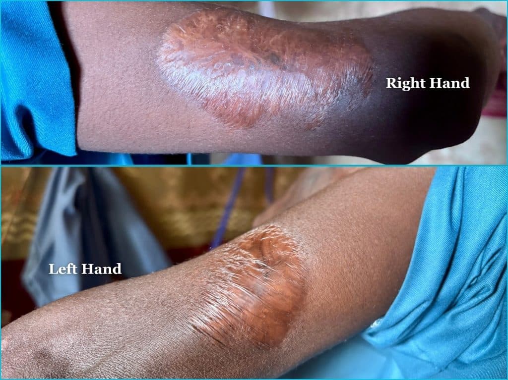 Close-up of arms with skin discoloration labeled "Right Hand" and "Left Hand," both wearing blue sleeves.