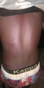 Bruises on the backs and foot of three of the arrested and brutalised youths