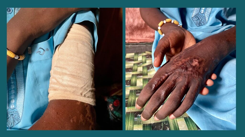A person with a beaded bracelet showing a bandaged arm in one frame and a healed scar in the other.