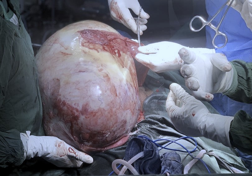 Surgeons in operation theater performing a procedure involving a large, exposed anatomical mass.