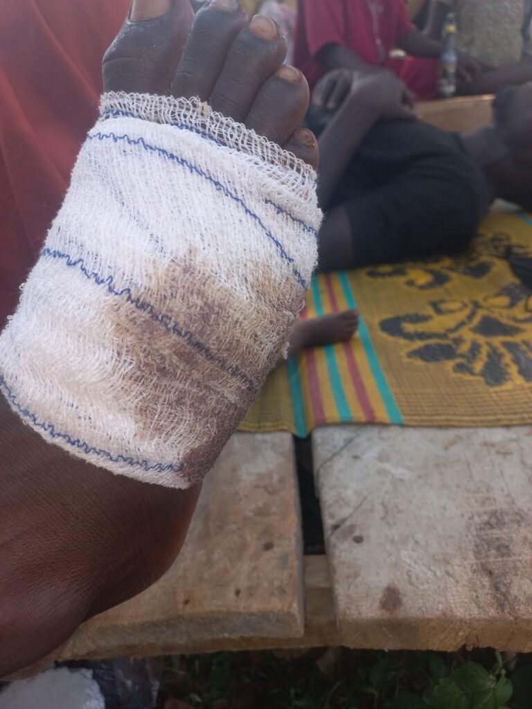 A person's bandaged hand with a visible wound, resting above wooden benches outdoors.