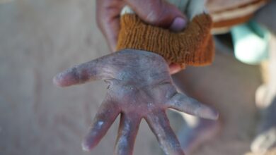 Hand of a child infected by a contagious skin disease.