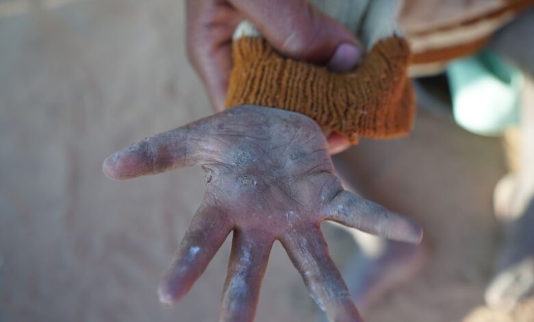 Hand of a child infected by a contagious skin disease.