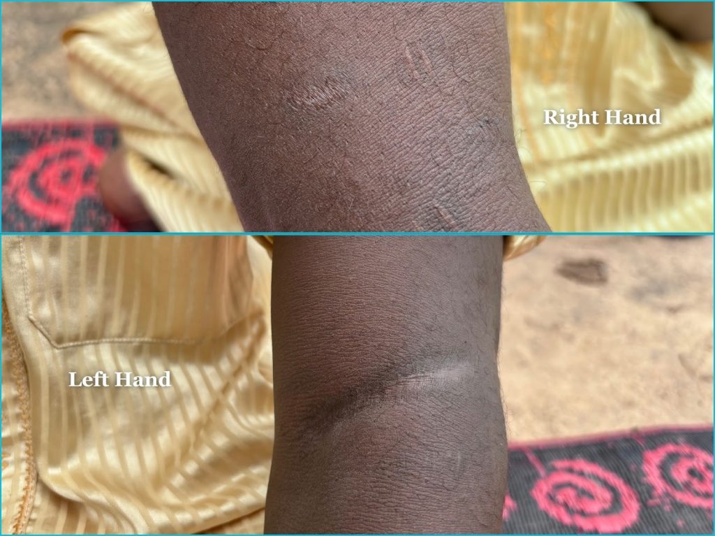 Close-up of a person's right and left arm showing dry skin texture against a yellow garment background.