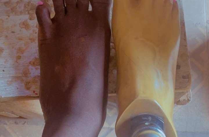 A foot next to a prosthetic foot on a wooden surface, both with pink nail polish.