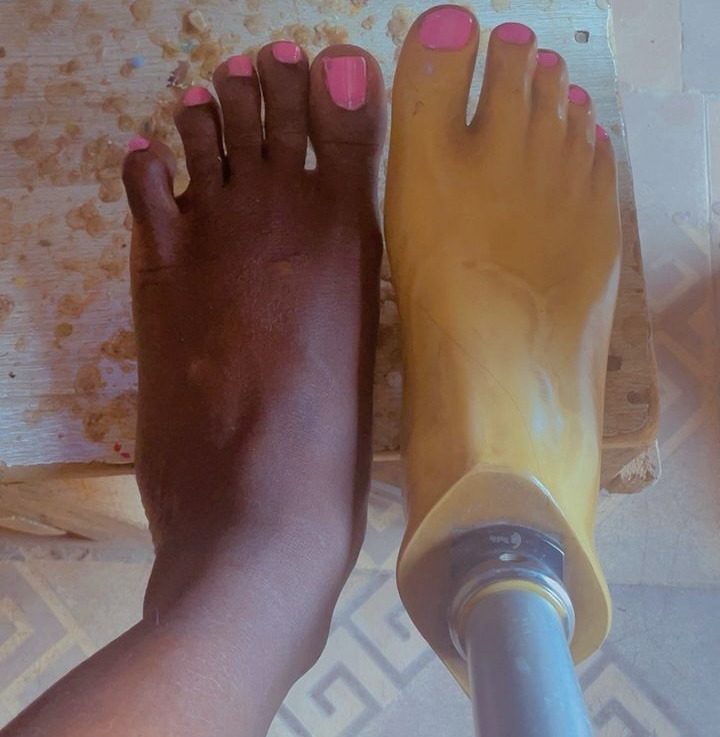 Nigerian Amputees Struggle With Prosthetics Not Made for Them