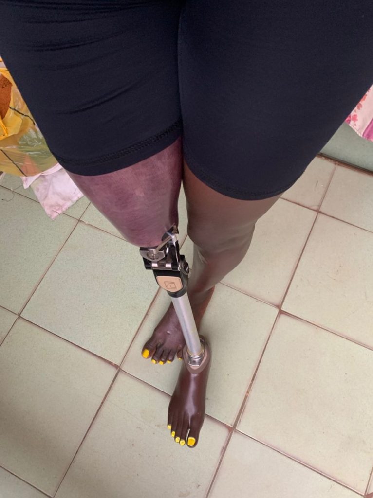 Person with a prosthetic leg stands on a tiled floor, wearing black shorts. Their toenails are painted yellow.