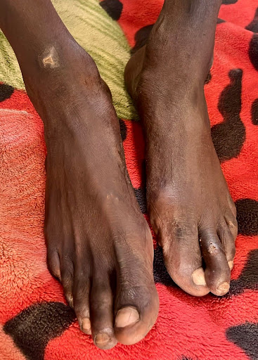 Two dark-skinned feet resting on a red and black patterned blanket, with a small scar visible on one ankle.