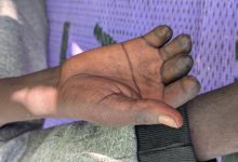 A close-up of a hand with blackened fingertips resting on a purple and gray surface.