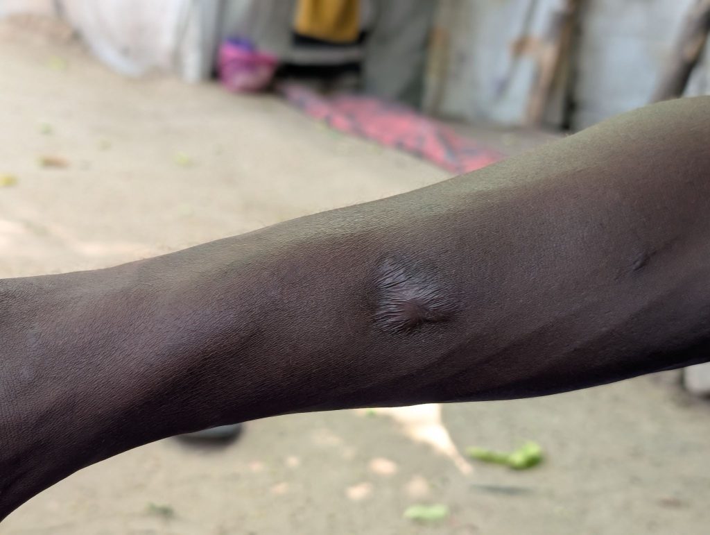 Close-up of a person's arm with a noticeable scar or raised mark on the skin, outdoors.